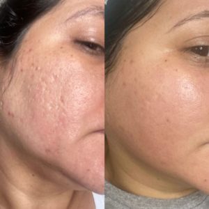 peeling-resultados-curso-treinamento-workshop-melasmas-acne-espinha-problema-de-pele-sete-300x300-1.jpg